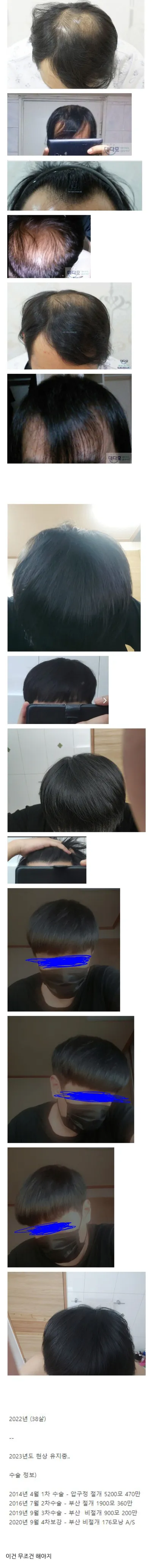 모발이식에 천만ㅇ을 쓰면 생기는 일 ㄷㄷ